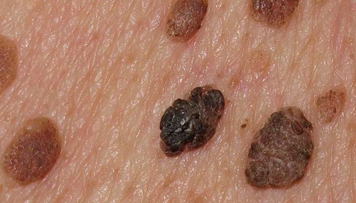 queratosis seborreica