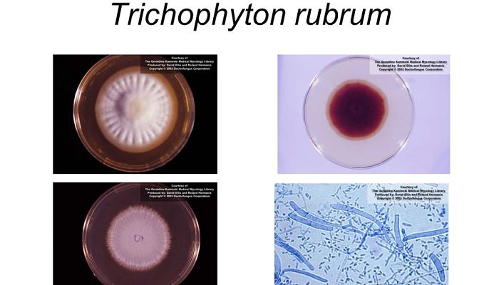 Trichophyton Rubrum 