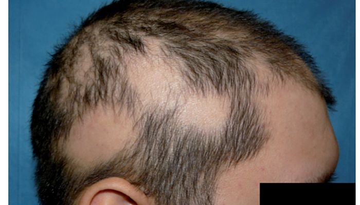 El síndrome del cabello anágeno suelto 